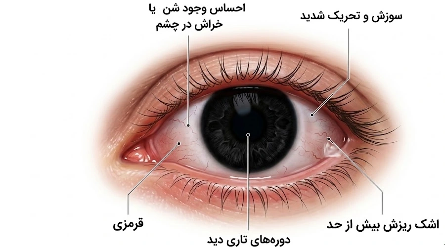 علائم خشکی چشم 