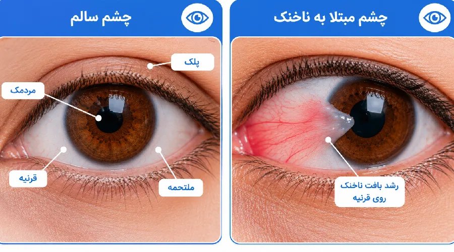 ناخنک چشم چیست؟