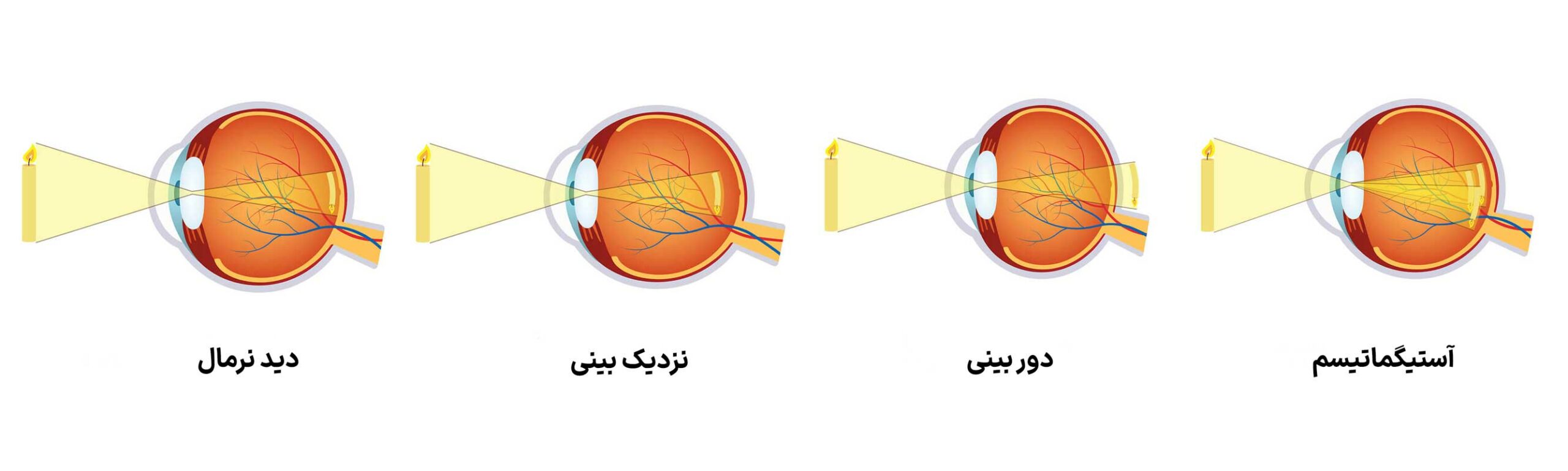 آستیگماتیسم، نزدیکبینی، دوربینی: عینک طبی چگونه به ما کمک میکند ...