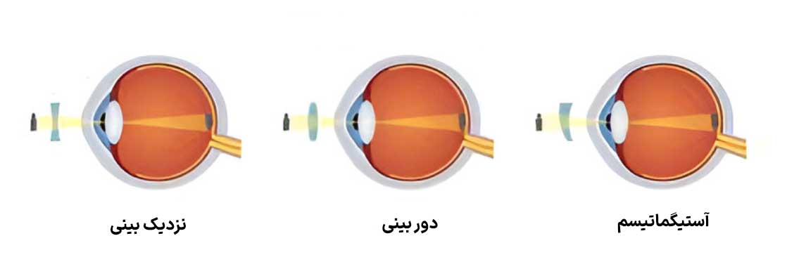آستیگماتیسم، نزدیک‌بینی، دوربینی: عینک طبی چگونه به ما کمک می‌کند؟
