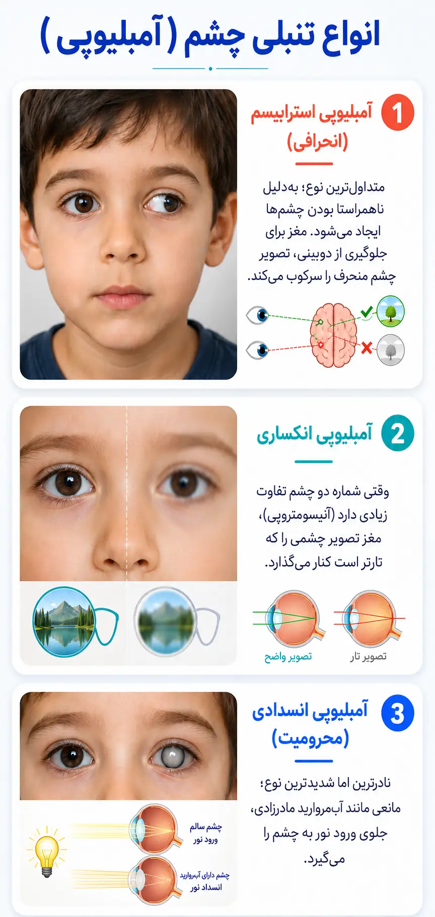 انواع تنبلی چشم 