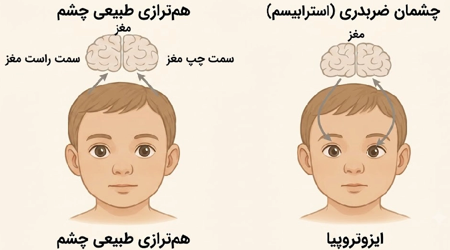 علت تنبلی چشم در کودکان