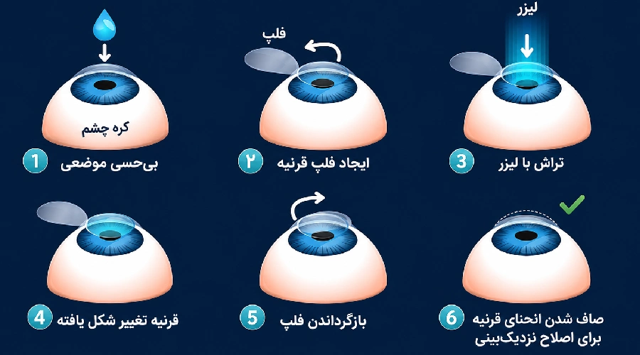 برگشت نمره بعد عمل لازک